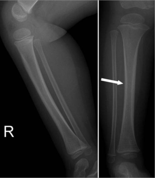 Tibial torus and toddler's fractures