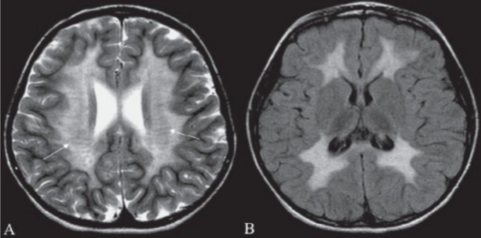 metachromatic leukodystrophy