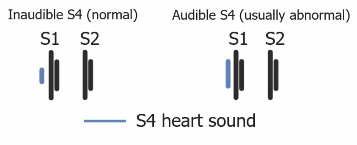 Timing and amplitude of s4
