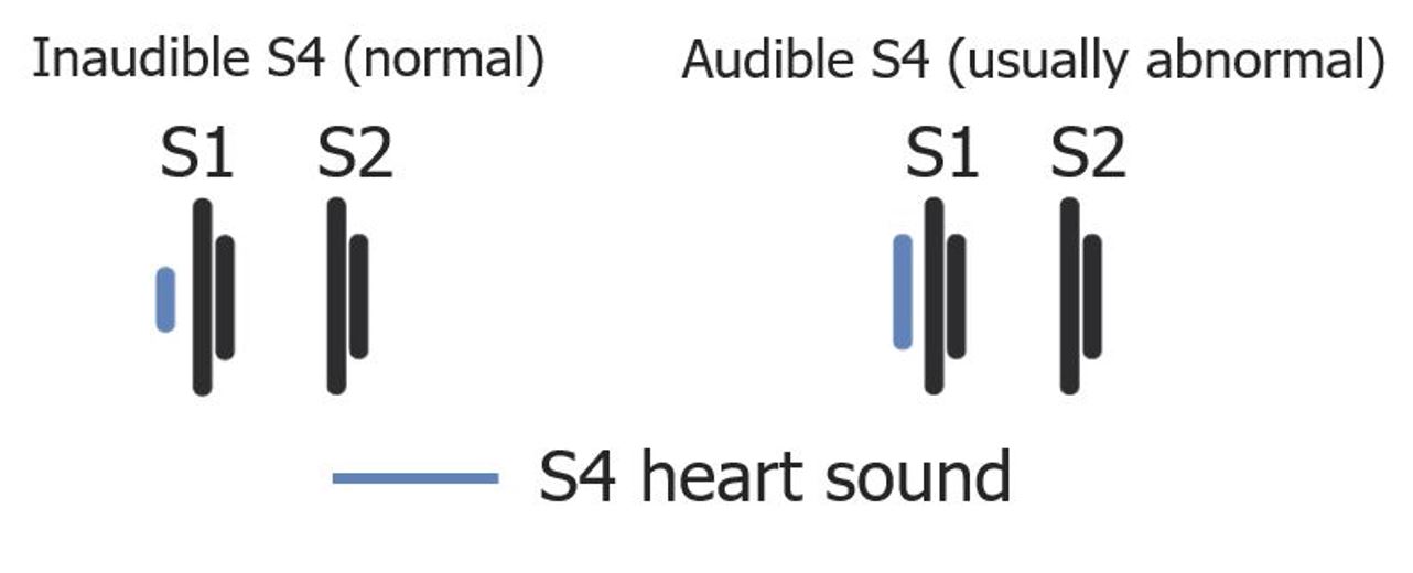 Heart Sounds Diagram S1 S2
