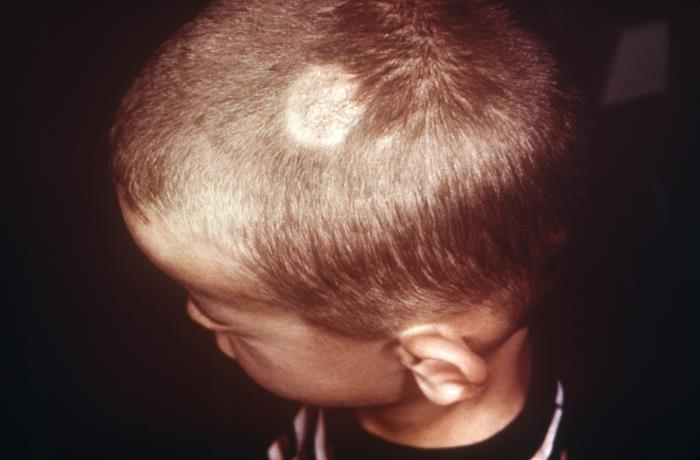 Tinea capitis on the scalp of a child