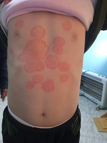 Dermatófitos/Infeções por Tinea