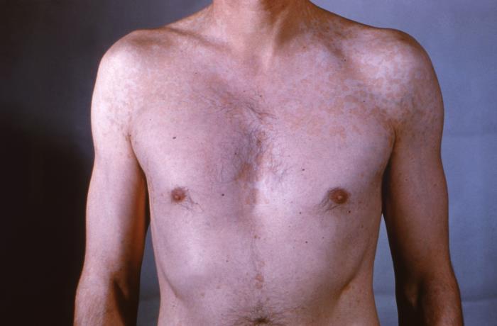 Foto de Medical: Tinea versicolor is a condition caused by the Malassezia  globosa fungus a form of yeasts. It is characterized by a skin discolor  eruption on the trunk and proximal extremities.