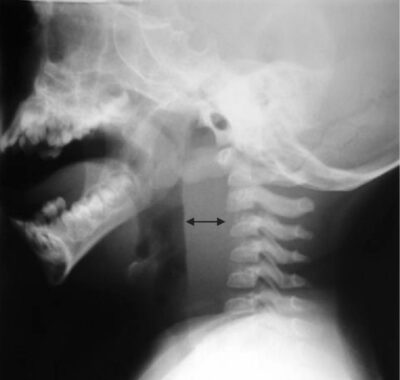 Retropharyngeal Abscess | Concise Medical Knowledge