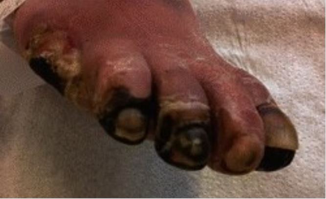 Gangrena do dedo do pé