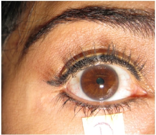 miotic pupil with normal reaction to light