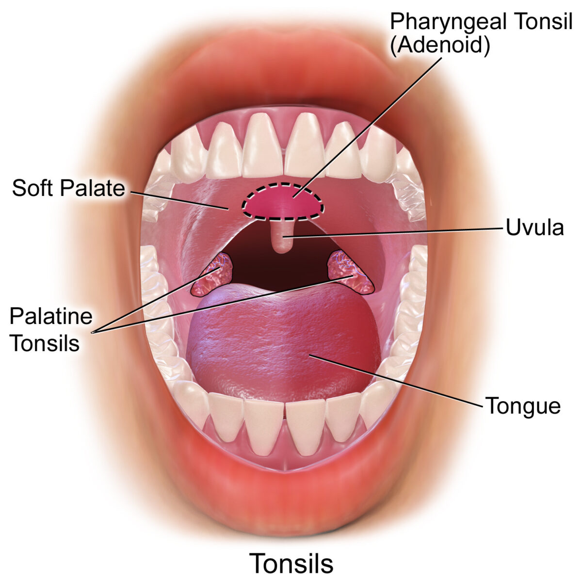 Tonsils in the oropharyngeal area