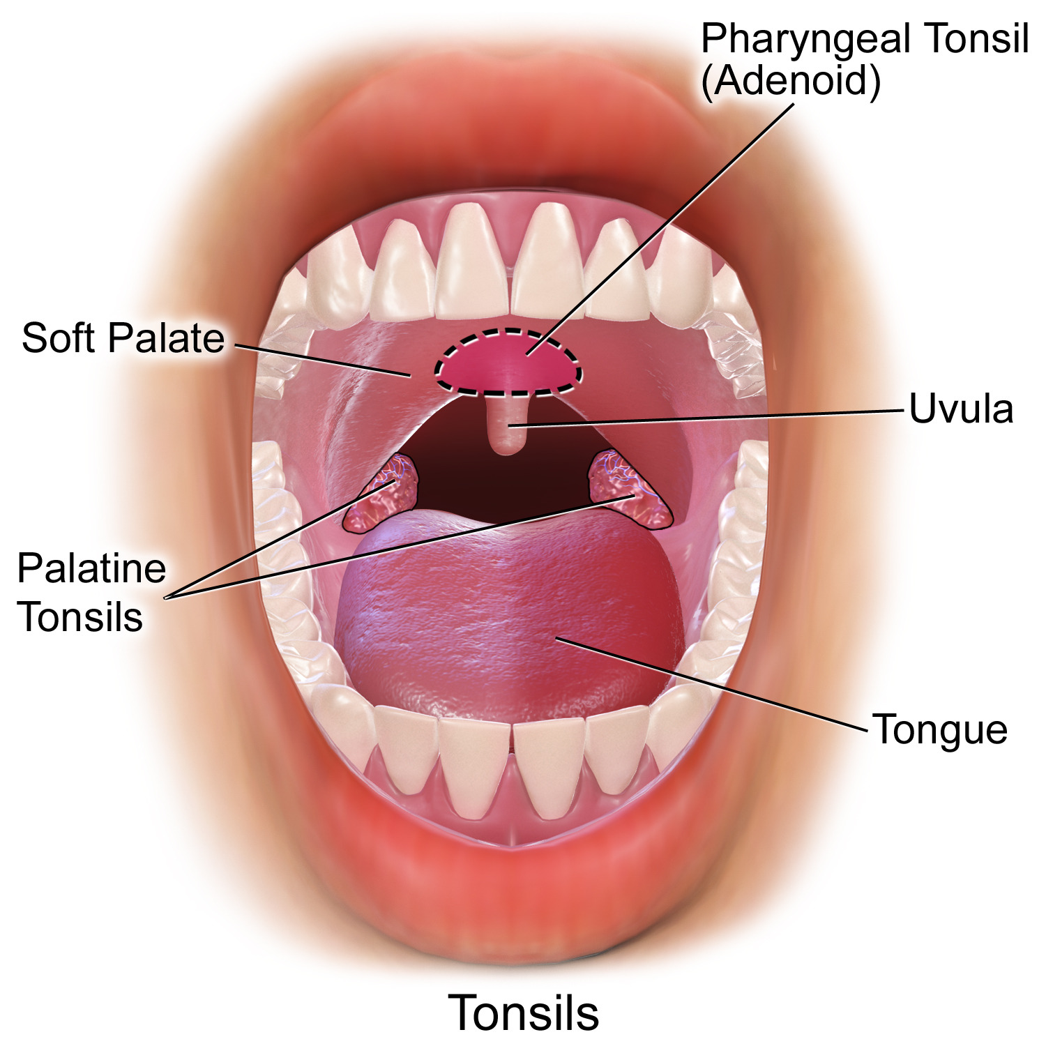 Amigdalitis Concise Medical Knowledge