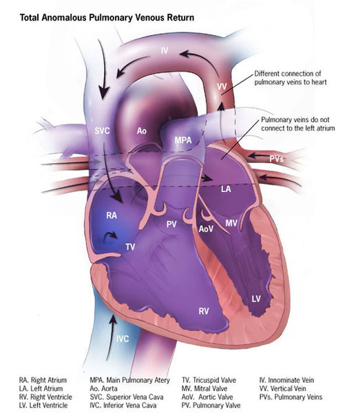 Patología del retorno venoso pulmonar total anómalo