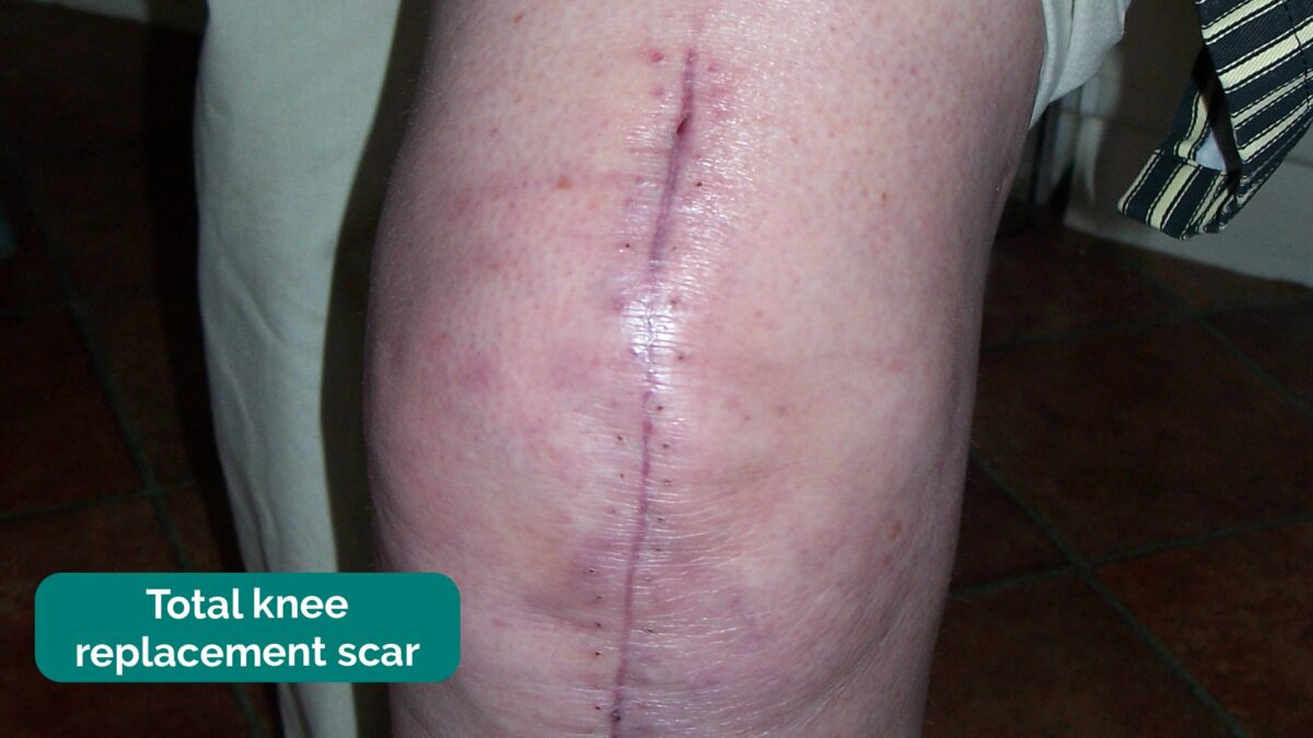 Total knee replacement scar noted on examination of the patient