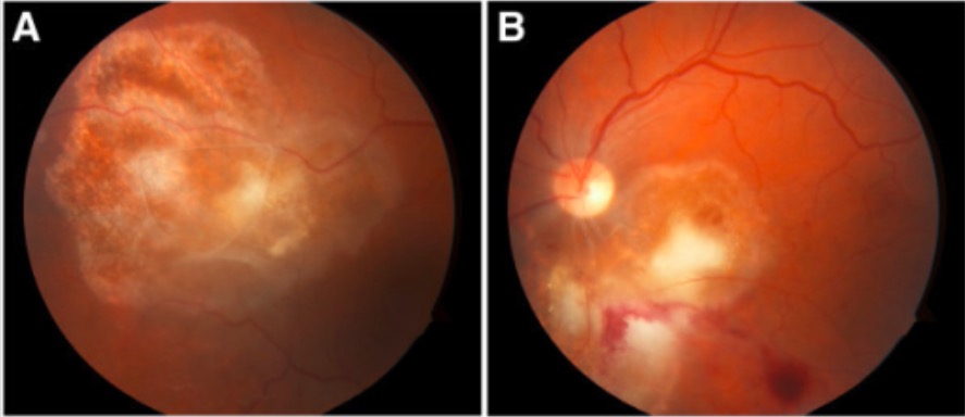 Toxoplasma retinochoroiditis