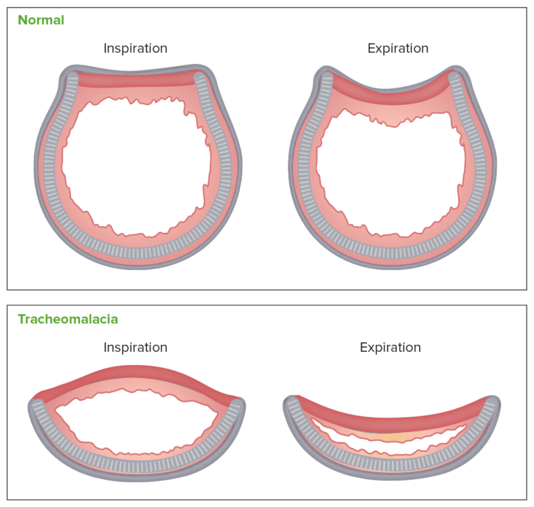 Laryngomalacia and Tracheomalacia Concise Medical Knowledge