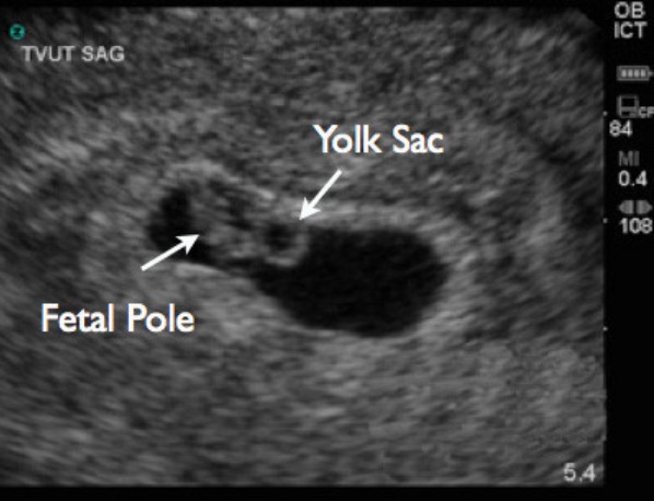 Trans-vaginal ultrasound image showing yolk sac and fetal pole