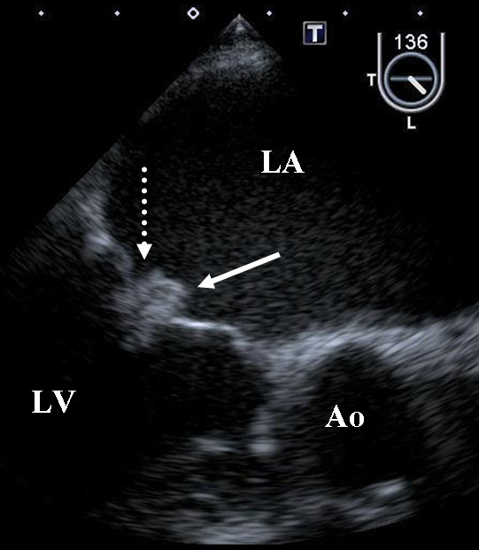 Transesophageal echocardiography demonstrating vegetations on the mitral valve
