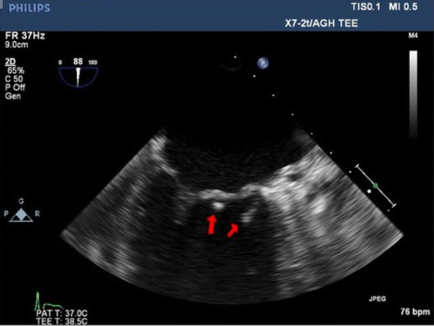 Transesophageal echocardiography image showing two vegetations
