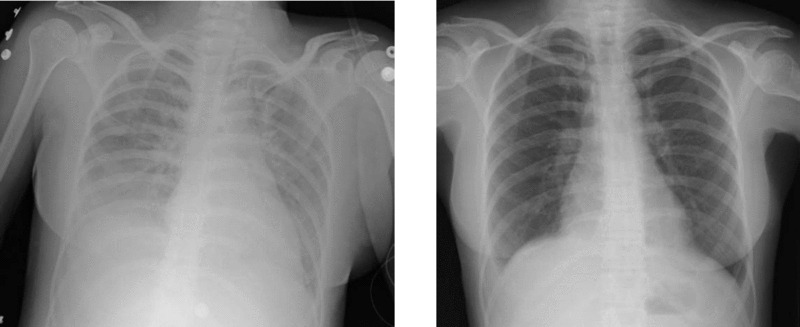 Transfusion-related acute lung injury chest x-ray