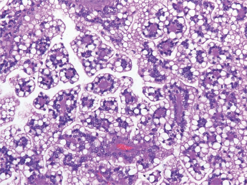 Carcinoma de células renales por translocación