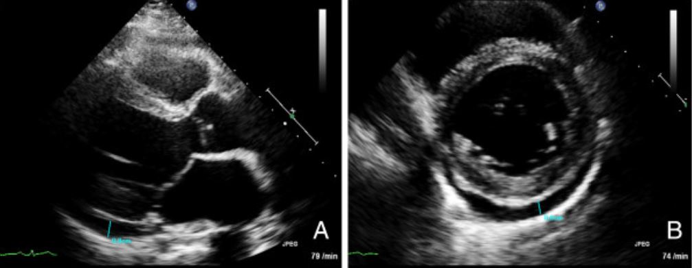 Imágenes de un ecocardiograma transtorácico en un paciente con miocarditis