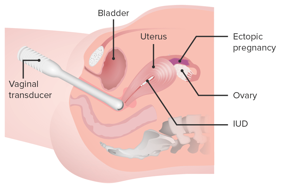 Transvaginal sonography