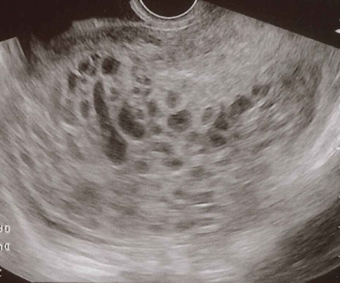 Ultrassonografia transvaginal imagem obstétrica de gravidez molar