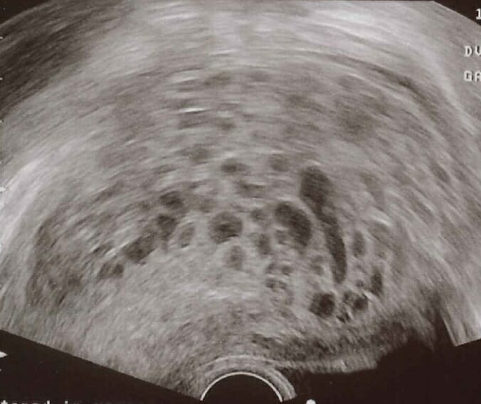 Transvaginal ultrasonography showing a molar pregnancy