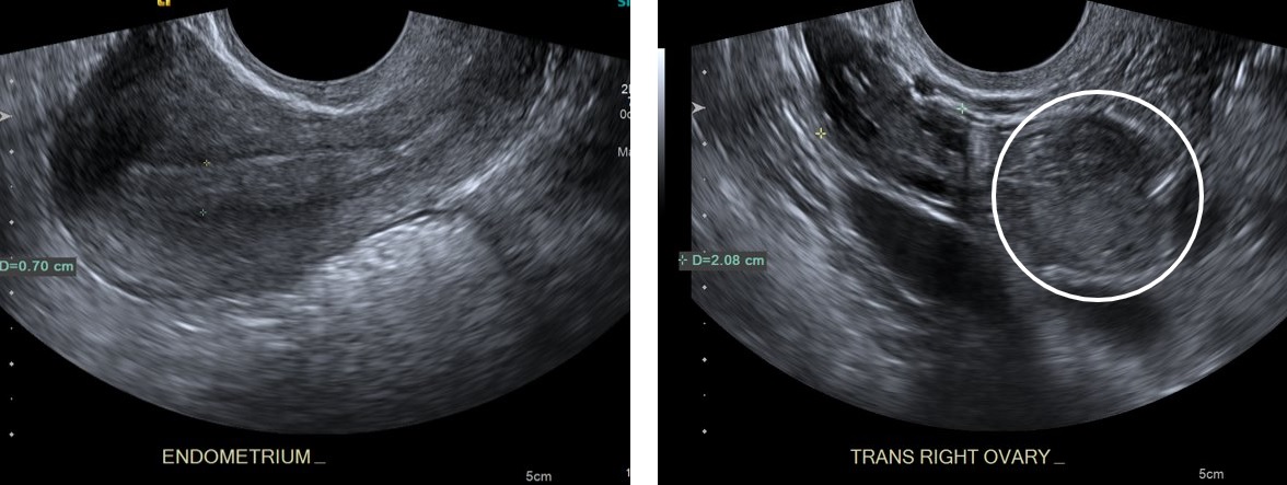 Ecografia transvaginal mostrando ovário de aspecto normal, com a