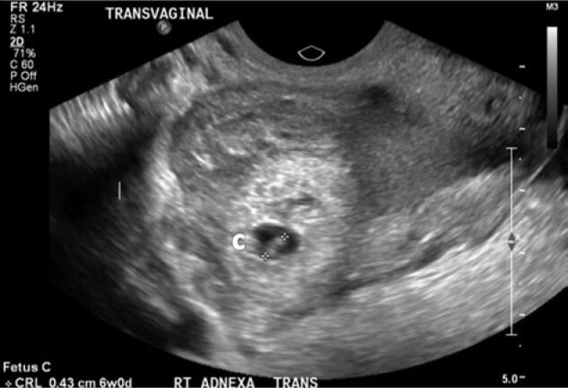 Transvaginal ultrasound of right adnexa showing right tubal ectopic pregnancy