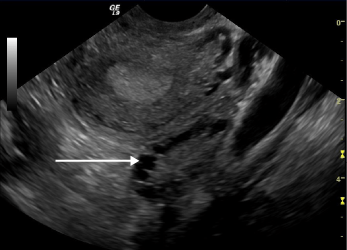 Transvaginal ultrasound showing a polycystic ovary