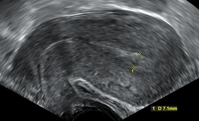 Transvaginal ultrasound showing a sagittal view of the uterus