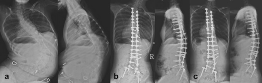 Treatment of neuromuscular scoliosis