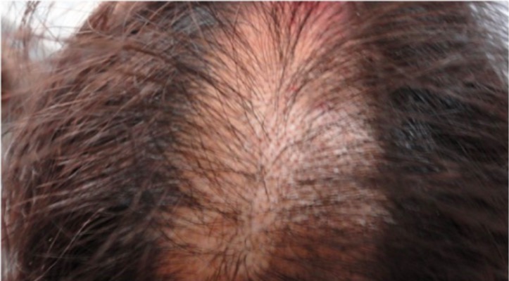 Lesões de tricotilomania no couro cabeludo