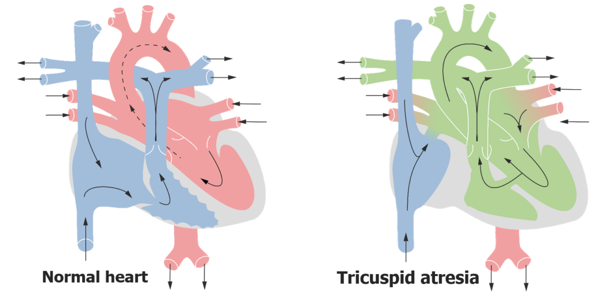 Fluxo sanguíneo cardíaco na atresia tricúspide: