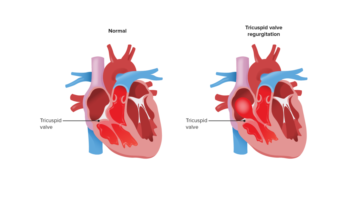 Regurgitación tricuspídea