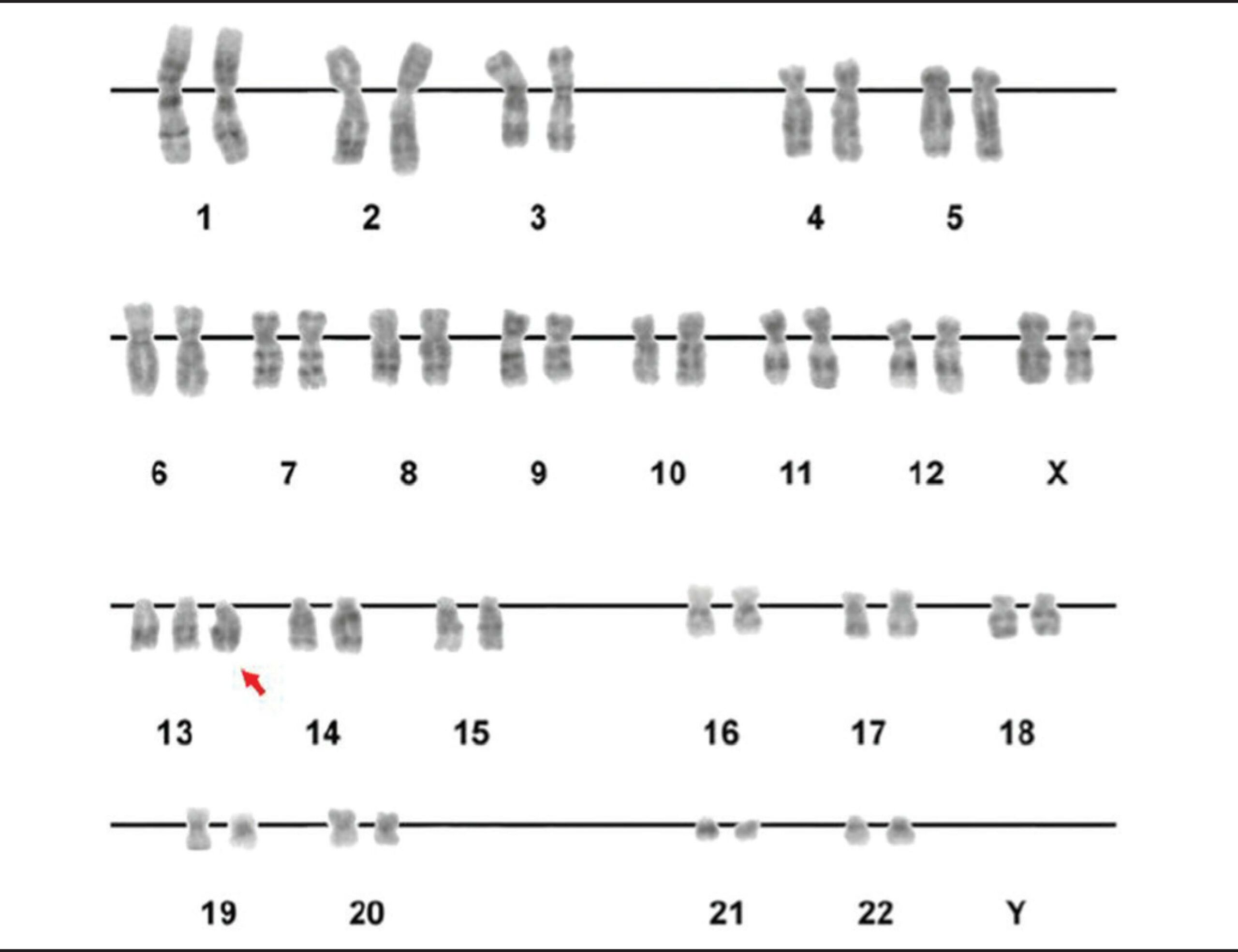 trissomia do cromossomo 13 – playok xadrez