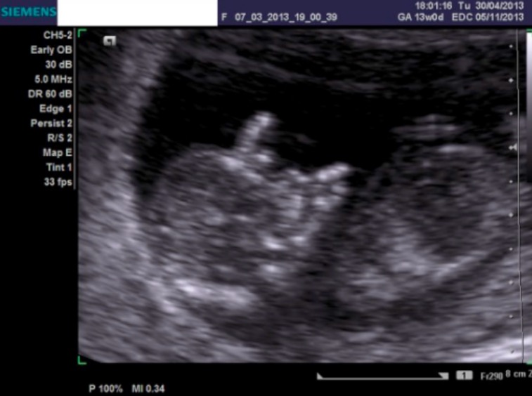 Trisomy 21 ultrasound