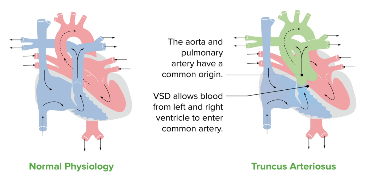 Truncus arteriosus anatomy