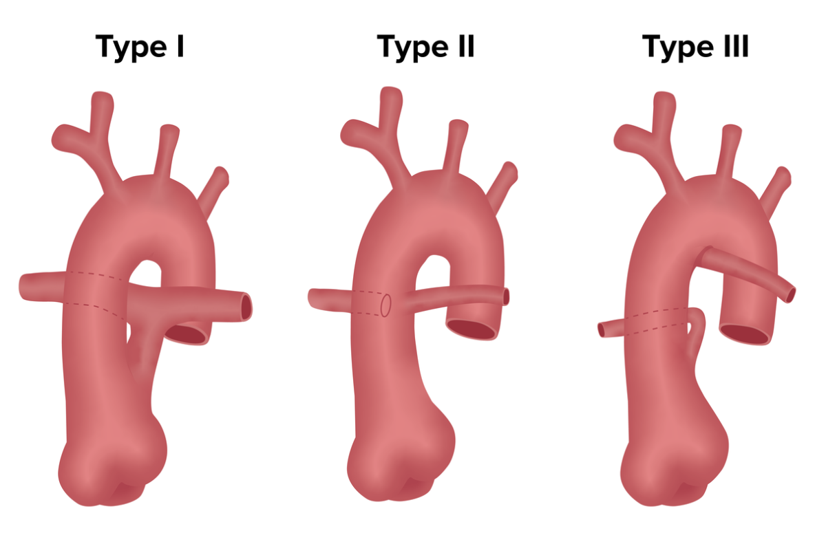 Clasificación del tronco arterioso