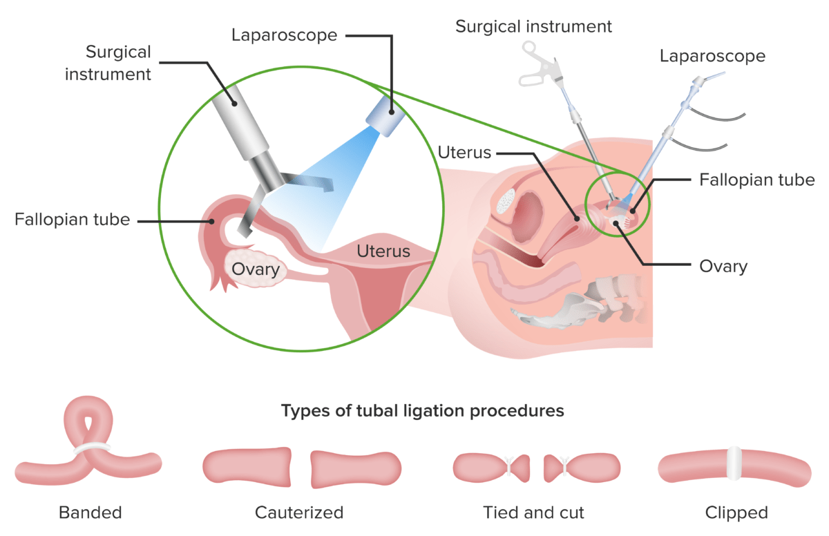 Tubal ligation