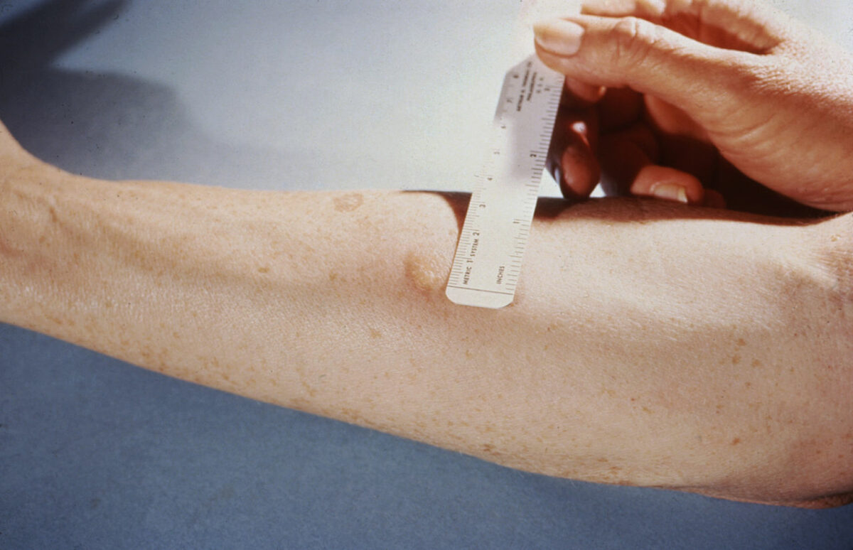 Tuberculin skin test for tuberculosis