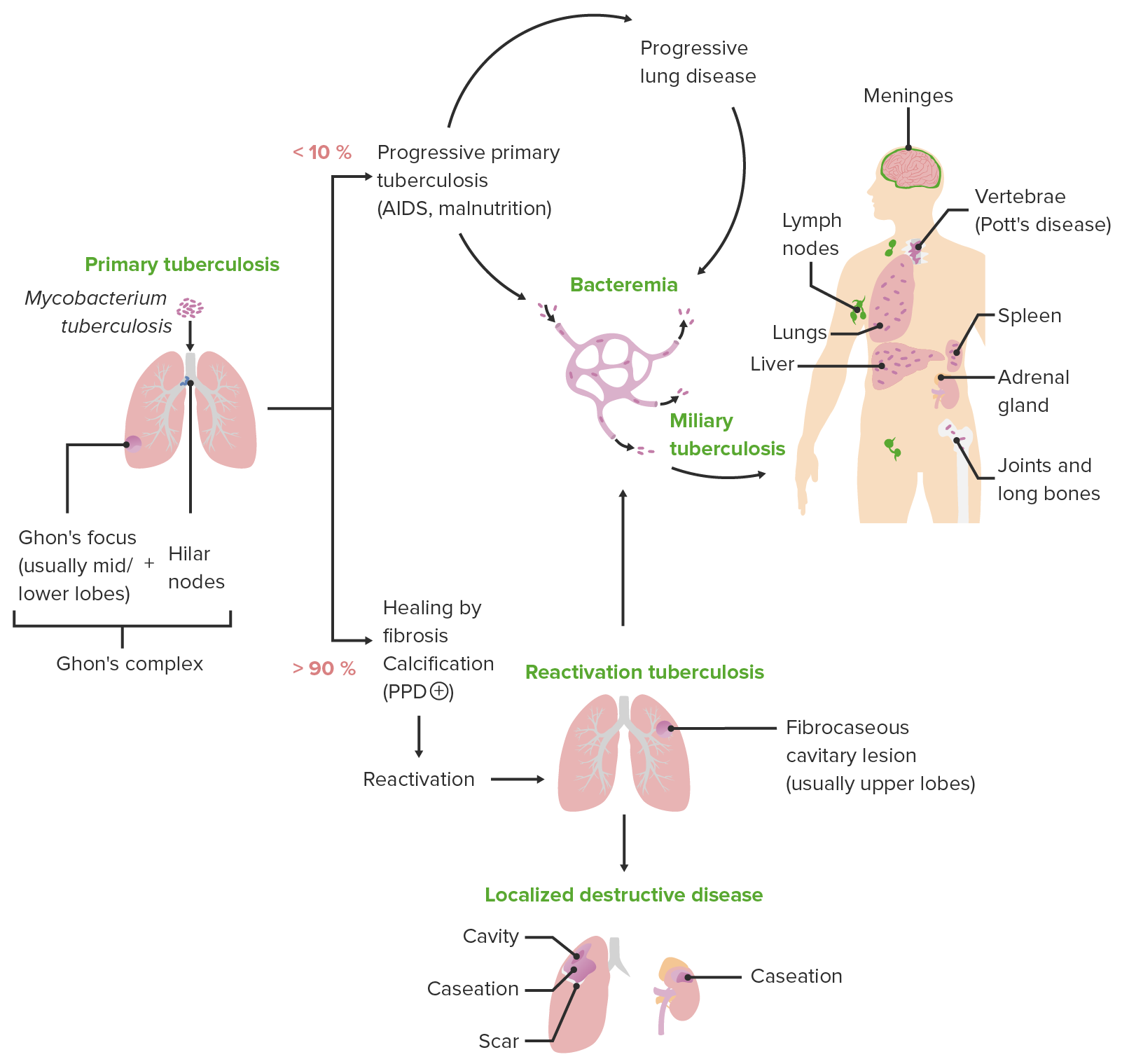 Tuberculosis | Concise Medical Knowledge