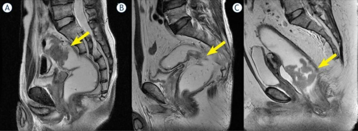 Tumor location with respect to the peritoneal reflection mri
