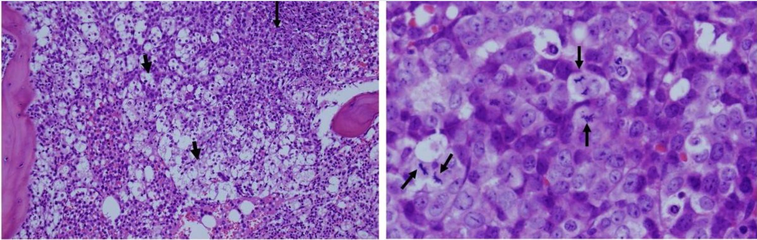 Tumor lysis syndrome in a patient with leukemia histology