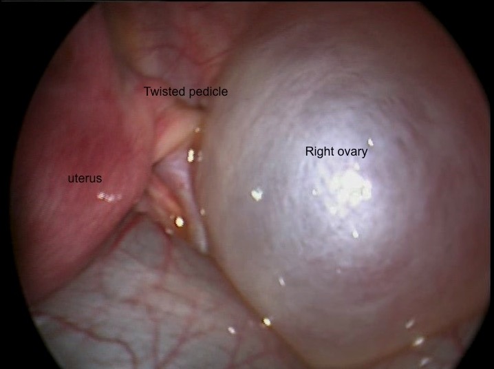 Twisted right ovarian cyst