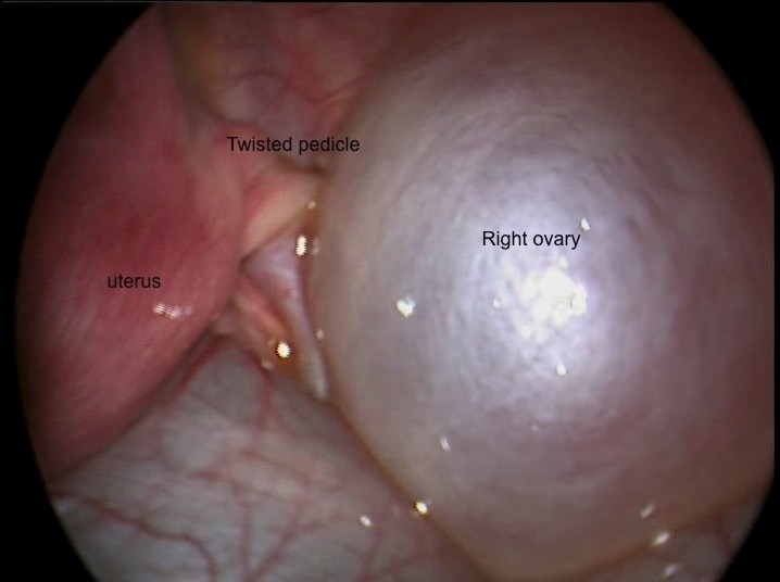 Ovarian Cysts  Concise Medical Knowledge