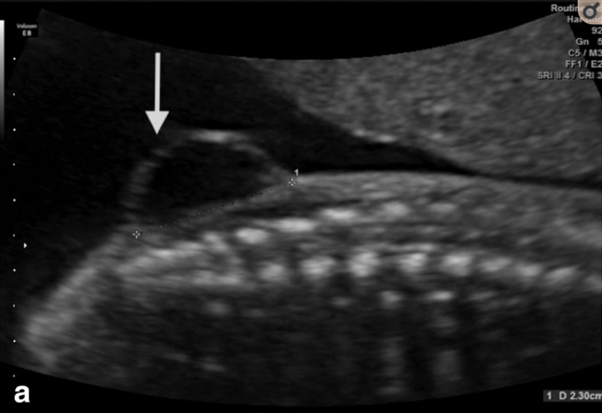 Two-dimensional ultrasound showing a meningocele
