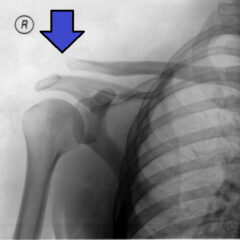 Type III acromioclavicular joint injury on x-ray