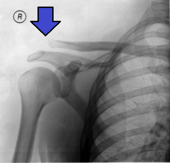 Type iii acromioclavicular joint injury on x-ray