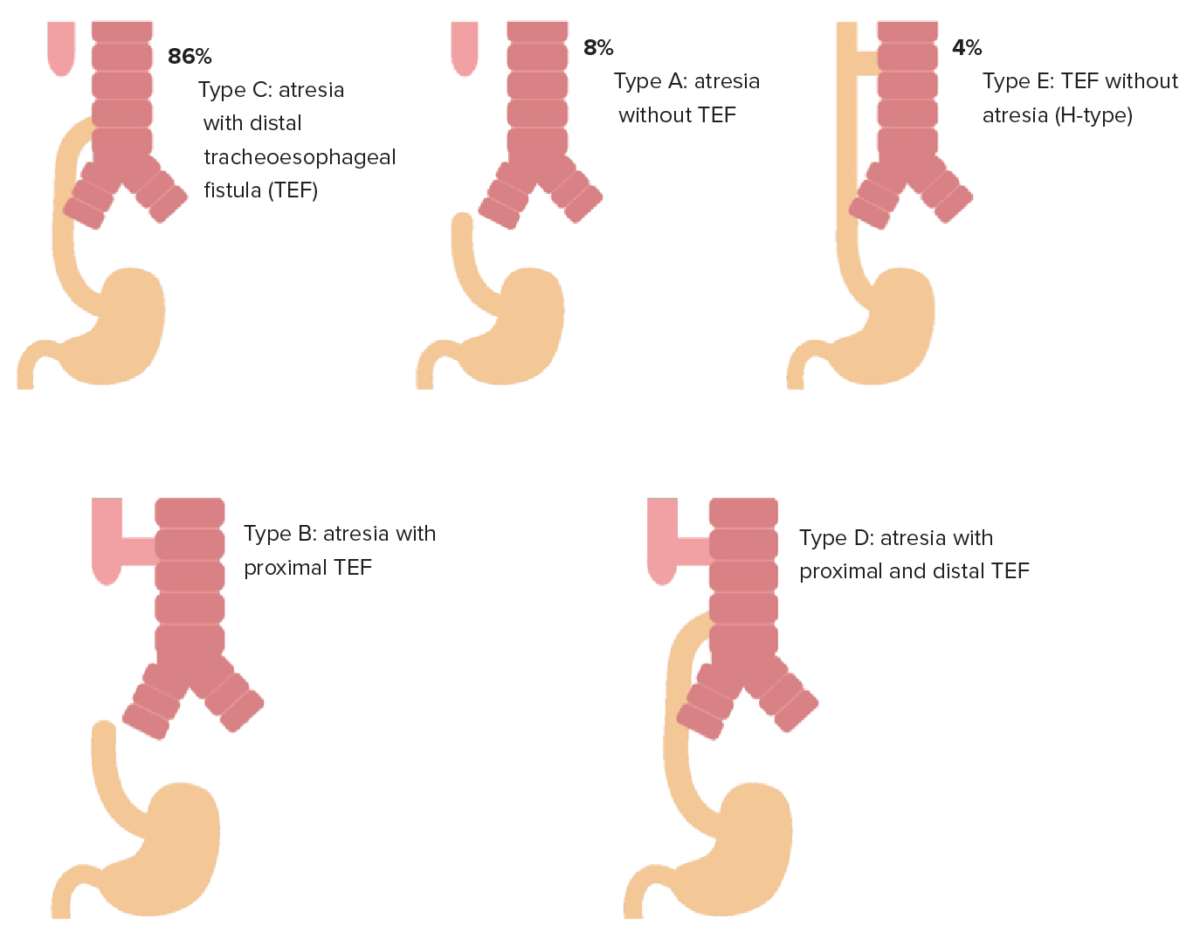 Esophageal Atresia Surgery