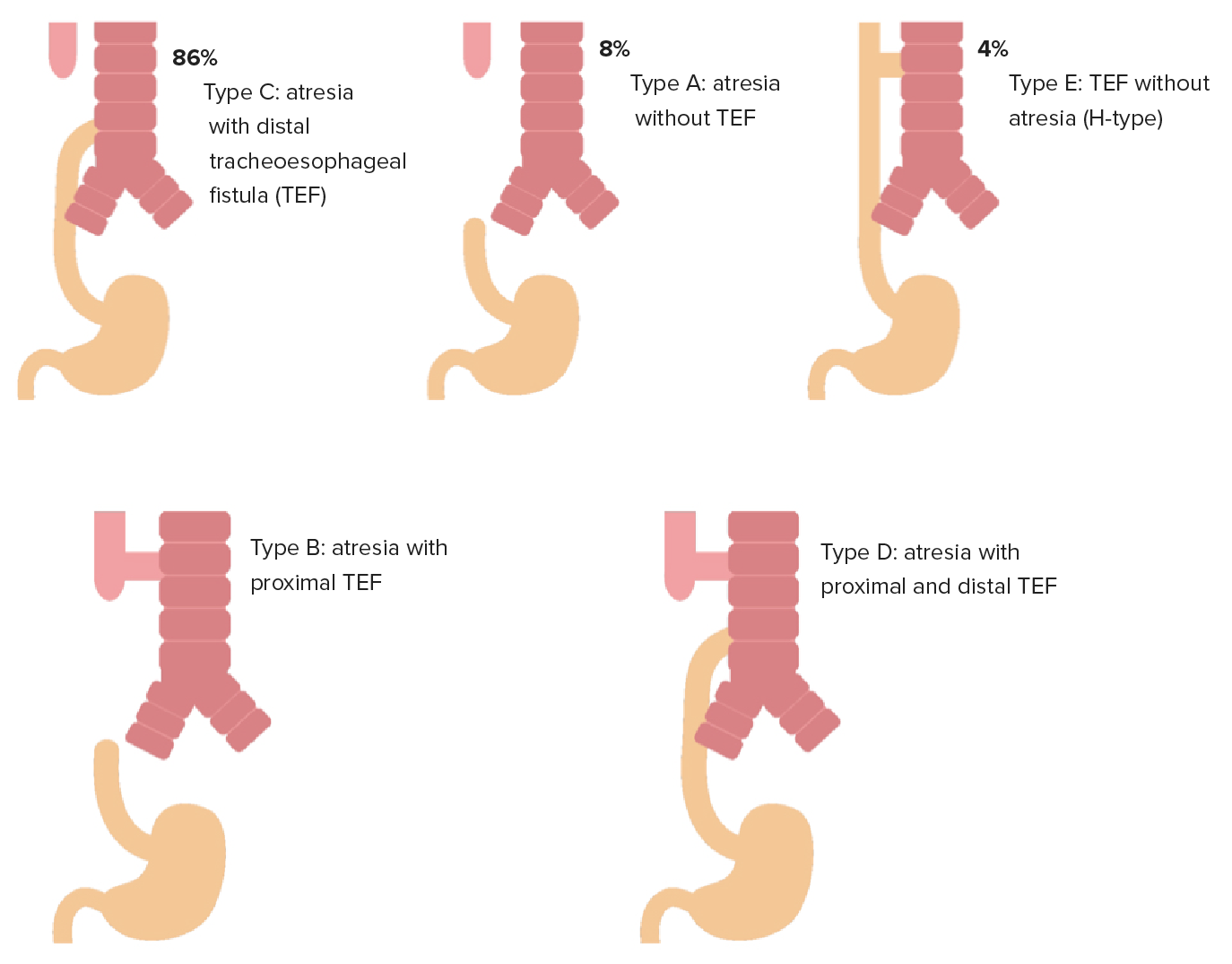 Esophageal Atresia With Distal Tracheoesophageal Fistul Open I - Gambaran