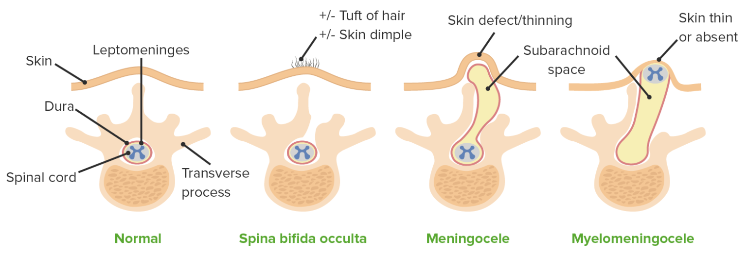 Defectos Del Tubo Neural | Concise Medical Knowledge